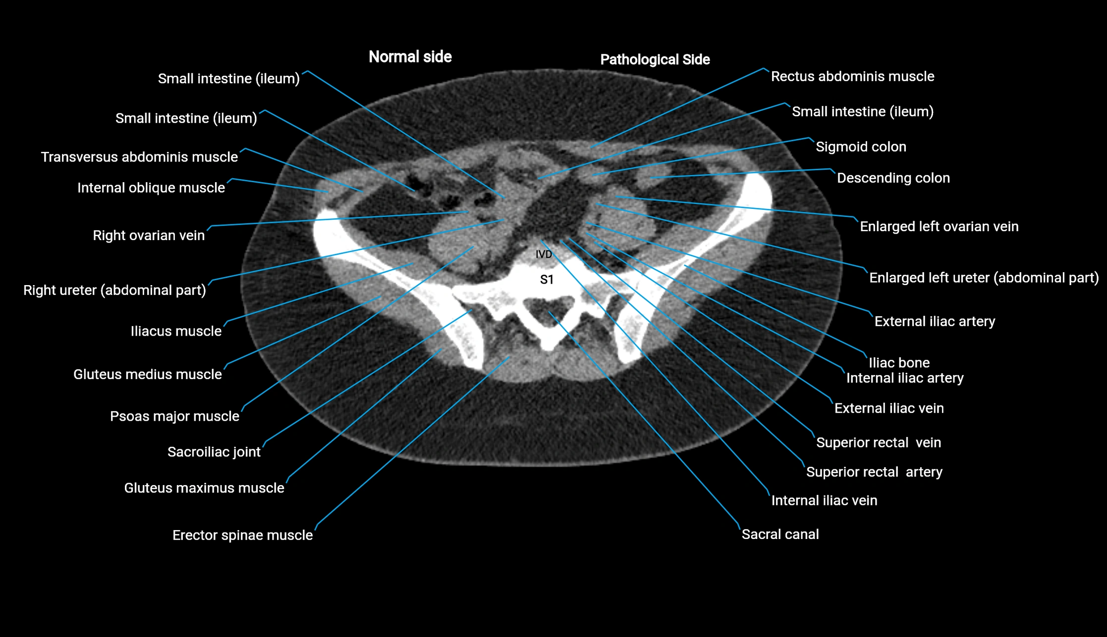 CT KUB axial cross sectional anatomy  radiology image -img-00201-00113.webp
